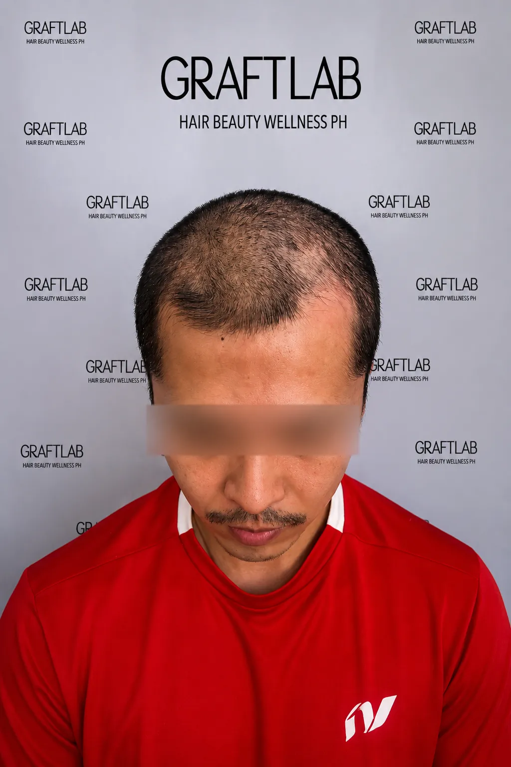 Before — male patient (J.M., 42), hairline restoration with 2,400 grafts (after photo at twelve months).