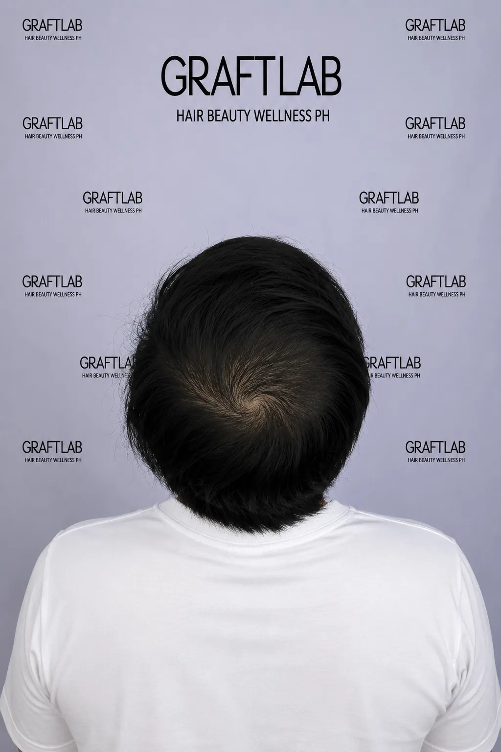After — male patient (A.R., 38), crown restoration with 2,800 grafts (after photo at six months).