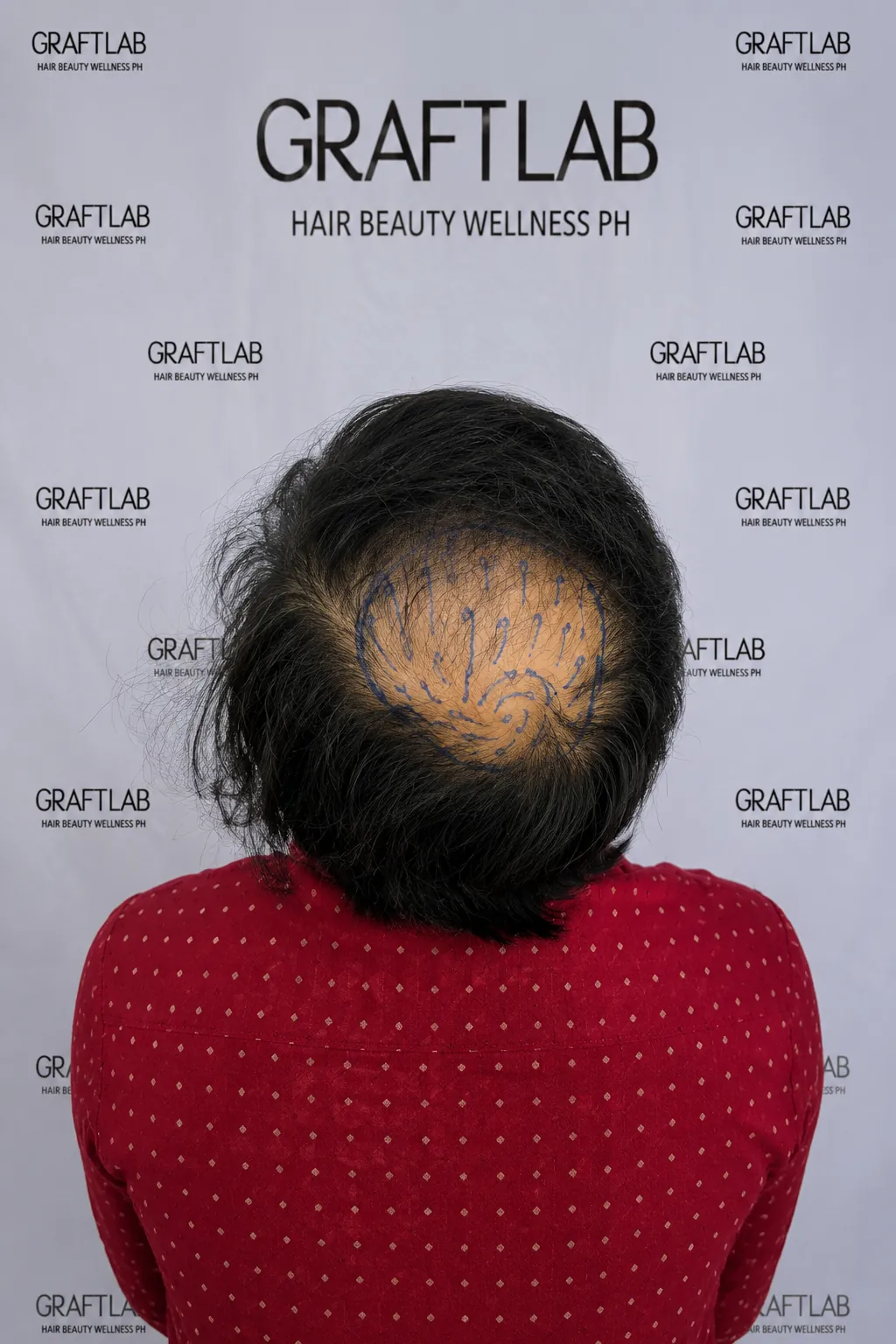 Before — male patient (A.R., 38), crown restoration with 2,800 grafts (after photo at six months).
