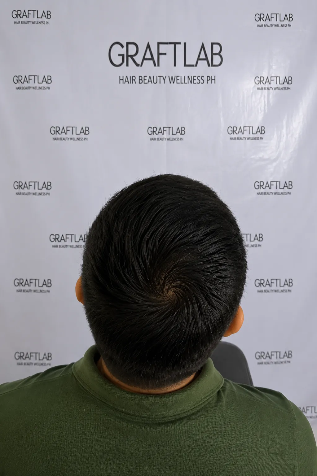 After — Full head restoration · 4,500 grafts · 12 months