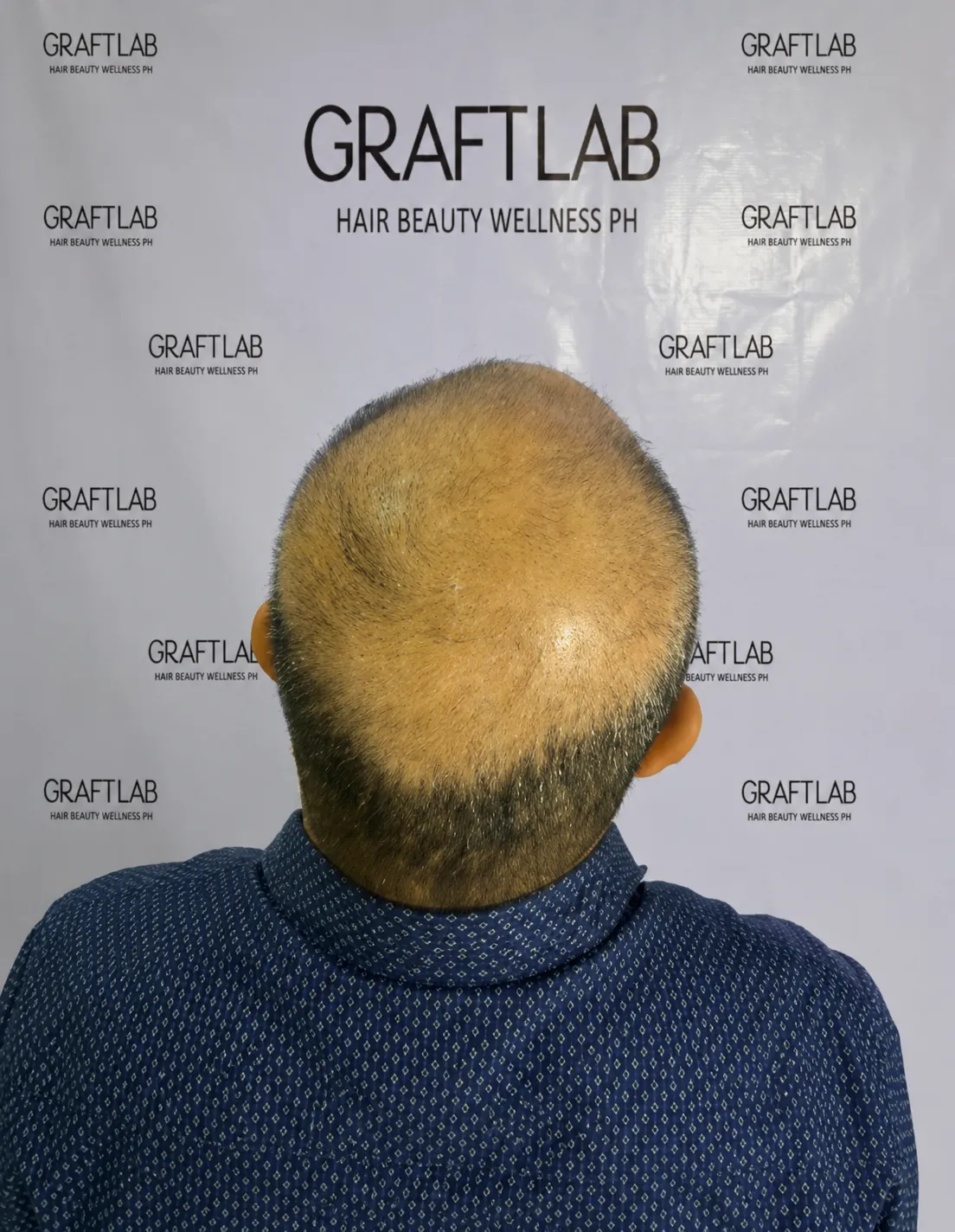 Before — Full head restoration · 4,500 grafts · 12 months