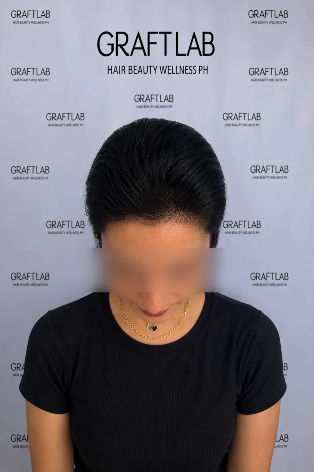 BA-004 after — Hairline lowering · 1,800 grafts · 12 months · L.C., 35