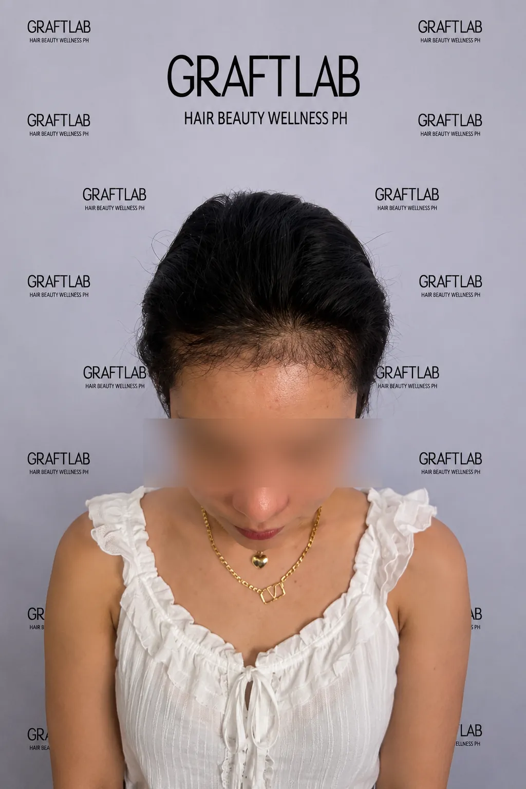 BA-004 before — Hairline lowering · 1,800 grafts · 12 months · L.C., 35
