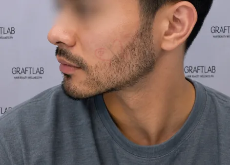 After — Beard & moustache · 1,200 grafts · 6 months