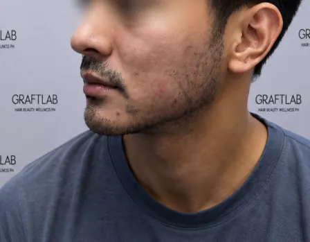 Before — Beard & moustache · 1,200 grafts · 6 months