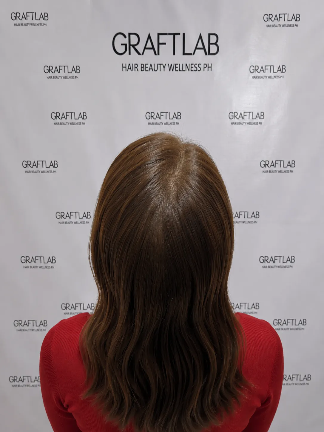 BA-006 after — Diffuse thinning · 2,000 grafts · 12 months · S.T., 41