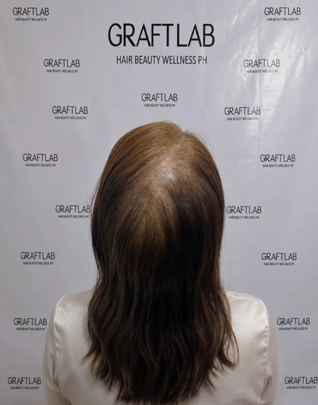 BA-006 before — Diffuse thinning · 2,000 grafts · 12 months · S.T., 41