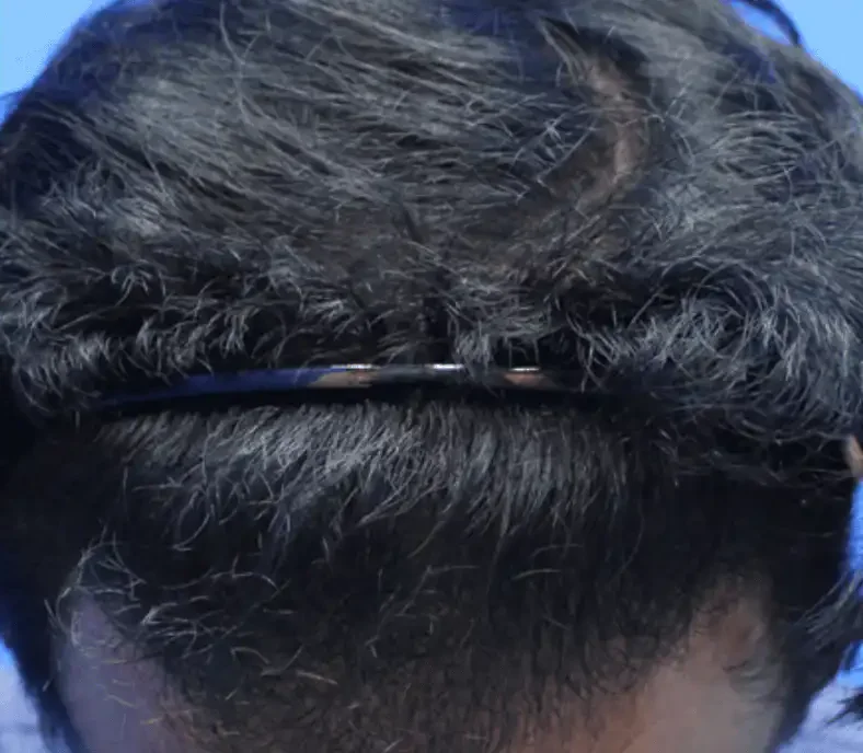 After — male patient, hairline restoration by Dr. Inder's team in Malaysia.