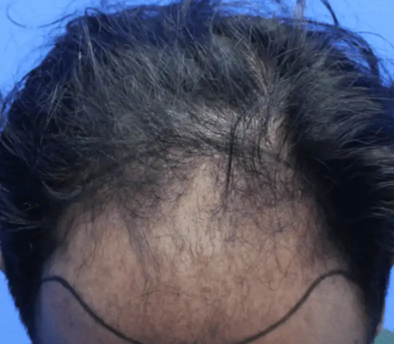 Before — male patient, hairline restoration by Dr. Inder's team in Malaysia.