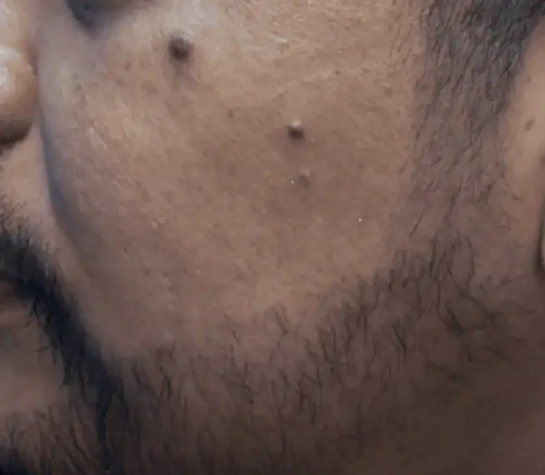 A filled-in beard along the cheek and jawline after a beard transplant by Dr. Inder's team in Malaysia.