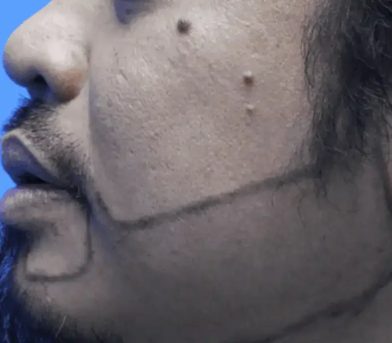 Before — male patient, beard restoration along the cheek and jawline by Dr. Inder's team in Malaysia.