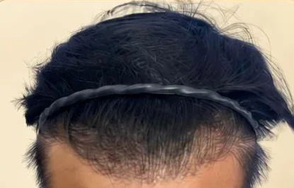 After — Hairline restoration · 3,000 grafts · 1 year · GraftLab Manila