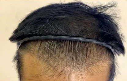 Before — Hairline restoration · 3,000 grafts · 1 year · GraftLab Manila