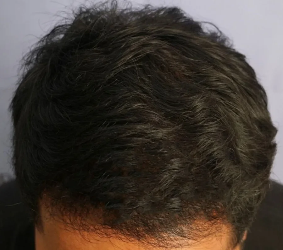 After — Crown restoration · GraftLab Manila
