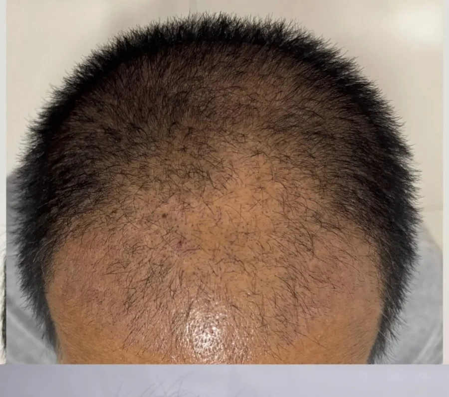 Before — Crown restoration · GraftLab Manila