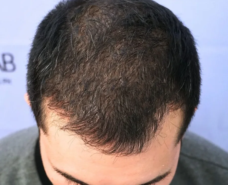 BA-012 after — Hairline restoration · GraftLab Manila