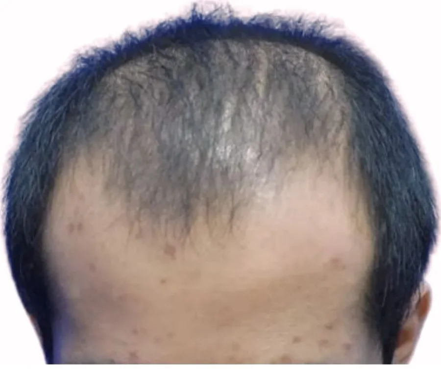BA-013 before — Hairline restoration · GraftLab Manila