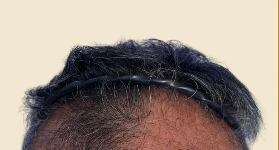 BA-015 after — Hairline restoration · 2 months · GraftLab Manila