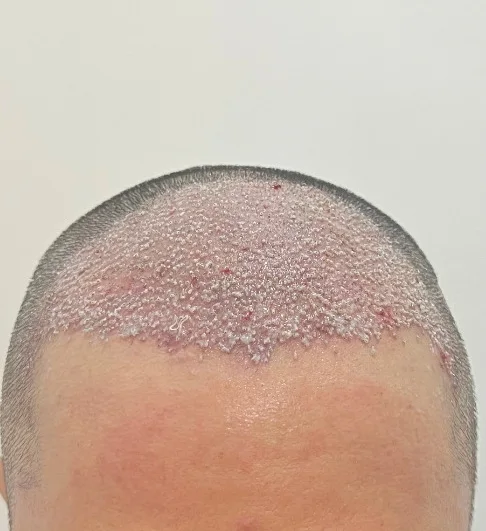 Hair transplant recovery, days 1–7: mild redness, tiny grafts settling