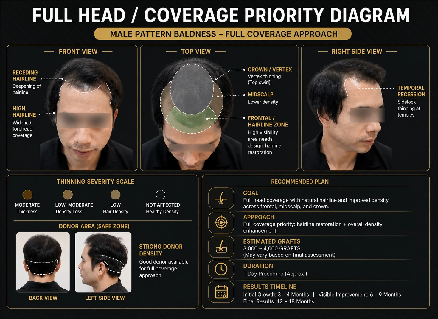 Diagram showing coverage priority across a male scalp for full-head hair restoration.