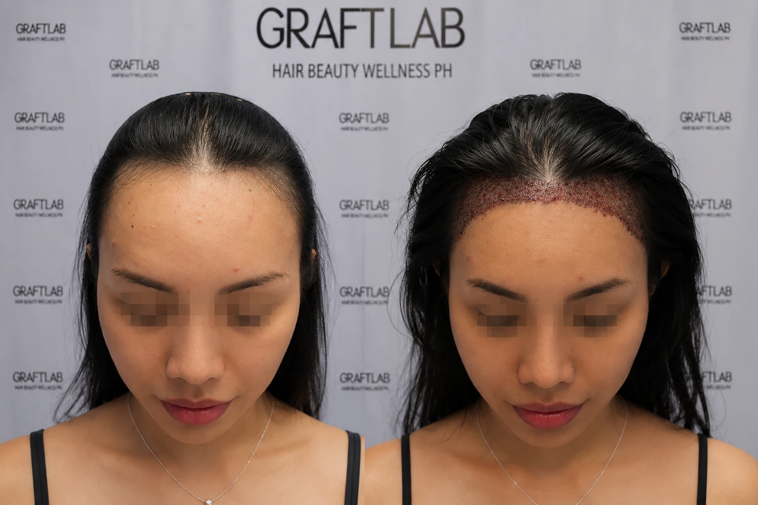 Female hairline design and lowering