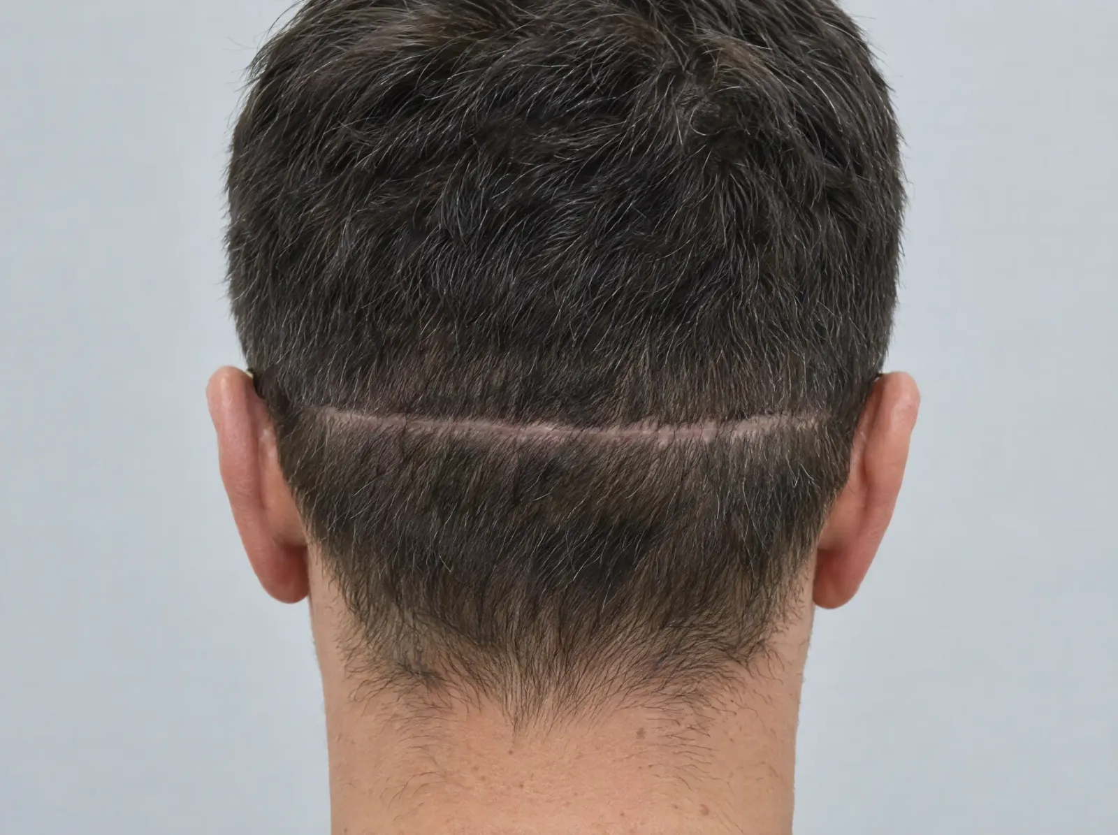 A healed linear scar across the donor area at the back of a man's scalp