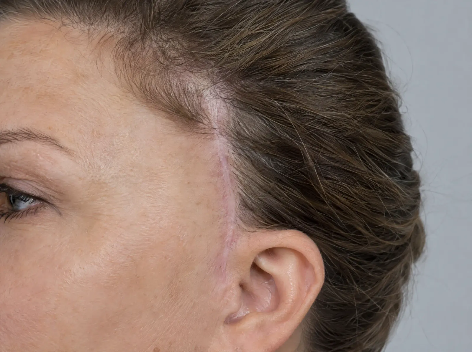 A healed facelift scar running into the temple hairline