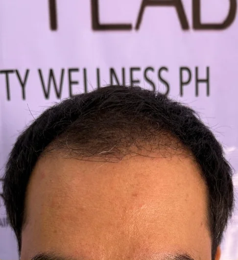 Hair transplant recovery, months 4–6: early growth coming through