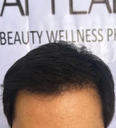 Hair transplant recovery, months 7–9: thicker, fuller coverage